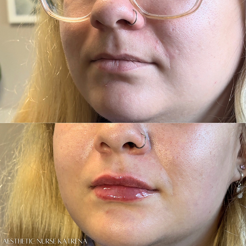 Mini Lip Filler Plump near me Oshawa | Courtice | Whitby | Bowmanville | Orono | Newcastle