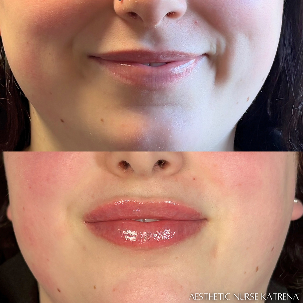 Mini Lip Filler Plump near me Oshawa | Courtice | Whitby | Bowmanville | Orono | Newcastle