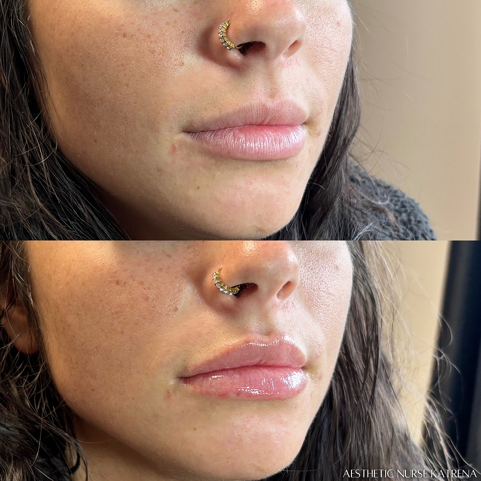 Mini Lip Filler Plump near me Oshawa | Courtice | Whitby | Bowmanville | Orono | Newcastle