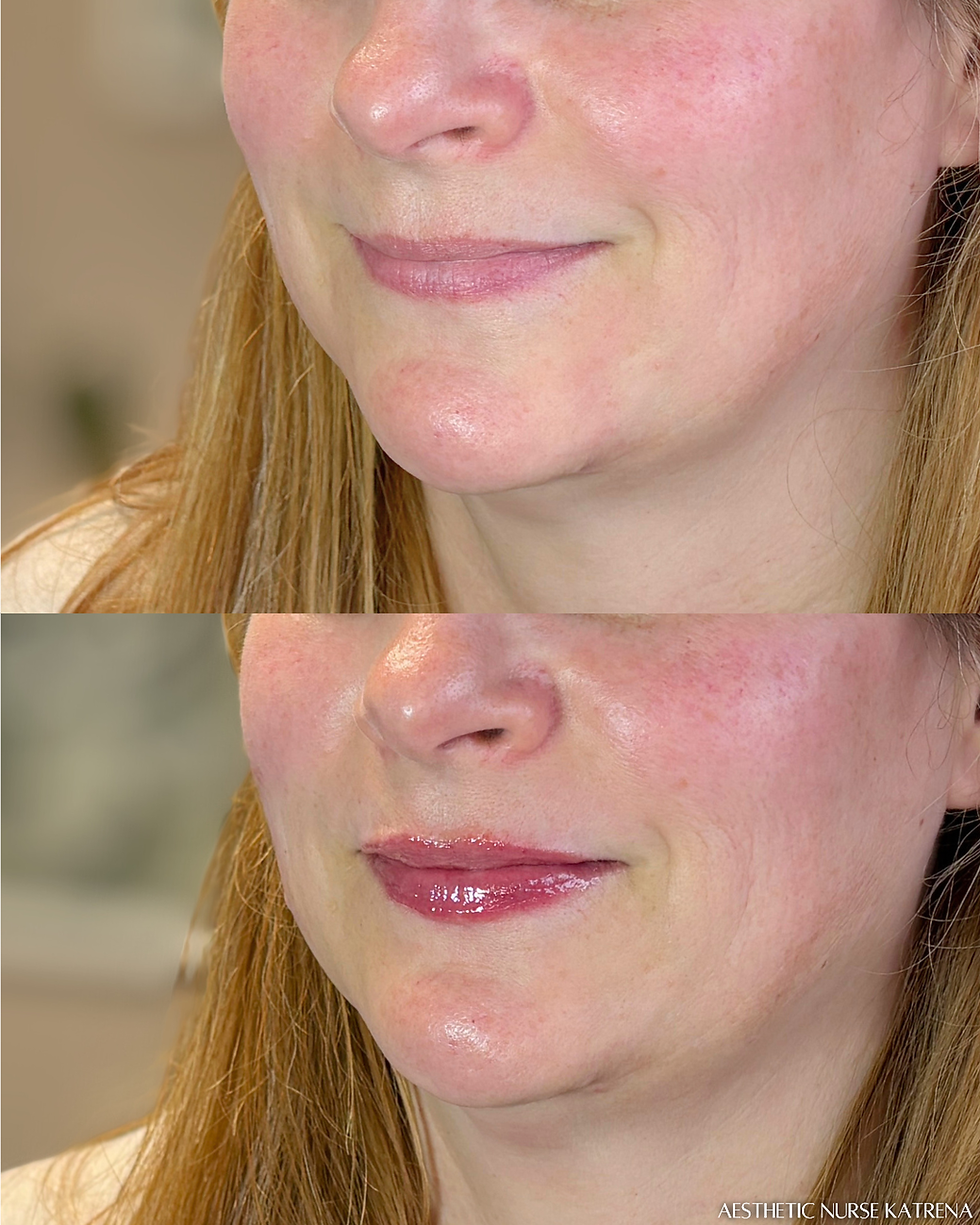 Mini Lip Filler near me Oshawa | Durham Region | Courtice | Whitby | Bowmanville | Orono | Ajax