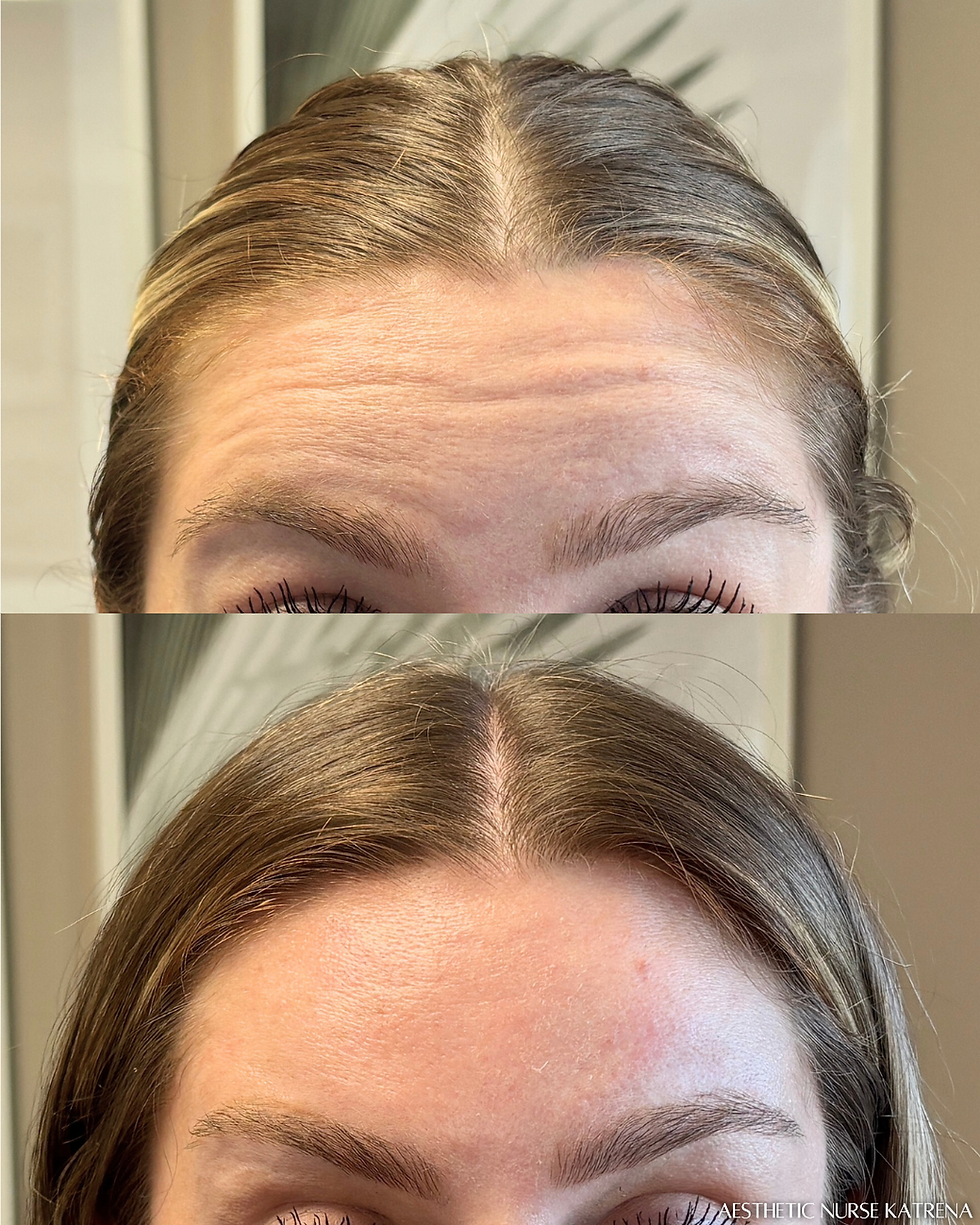 Forehead Lines Botox near me Oshawa | Durham Region | Courtice | Whitby | Bowmanville | Orono | Ajax