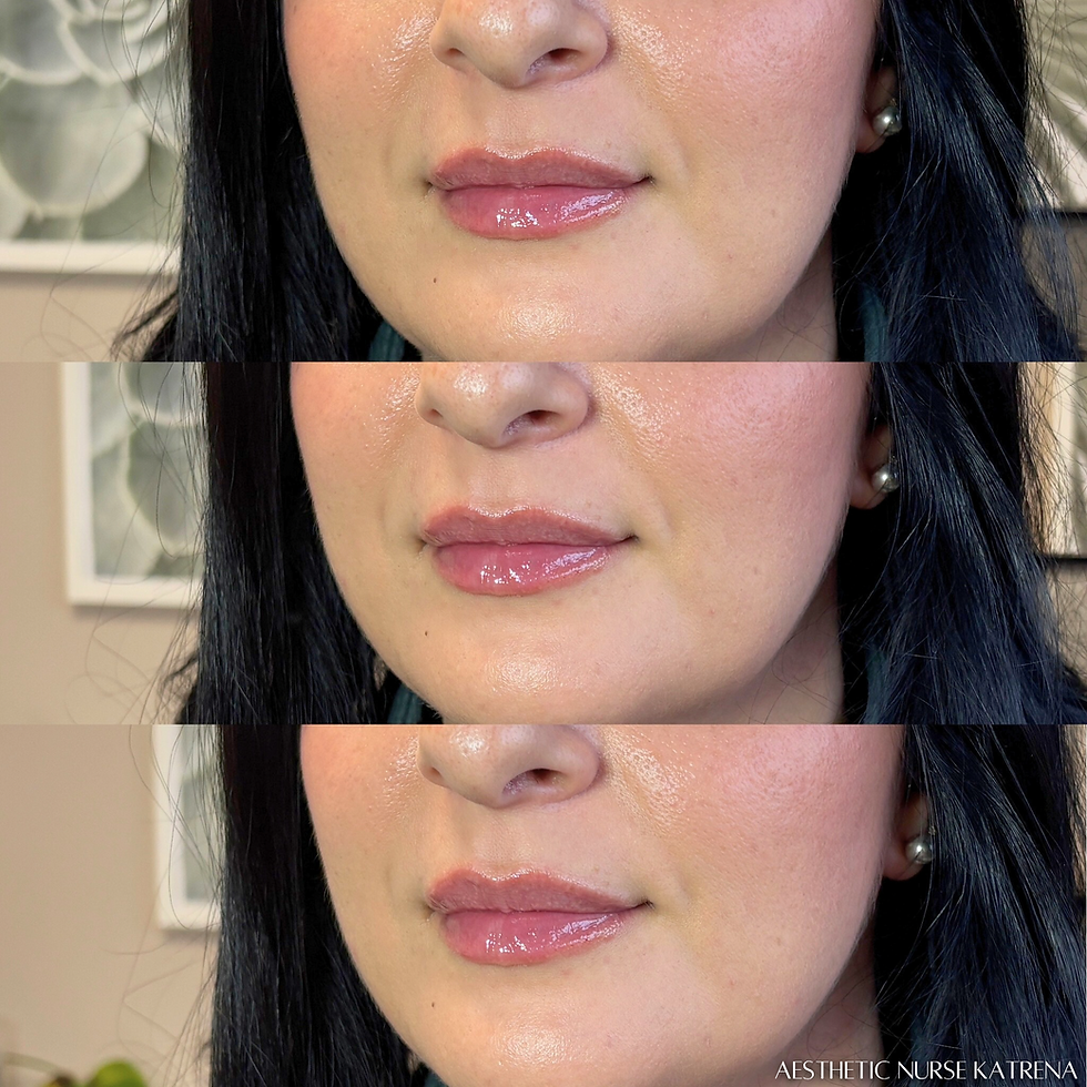 Mini Lip Filler near me Oshawa | Courtice | Whitby | Bowmanville | Orono | Newcastle | Ajax