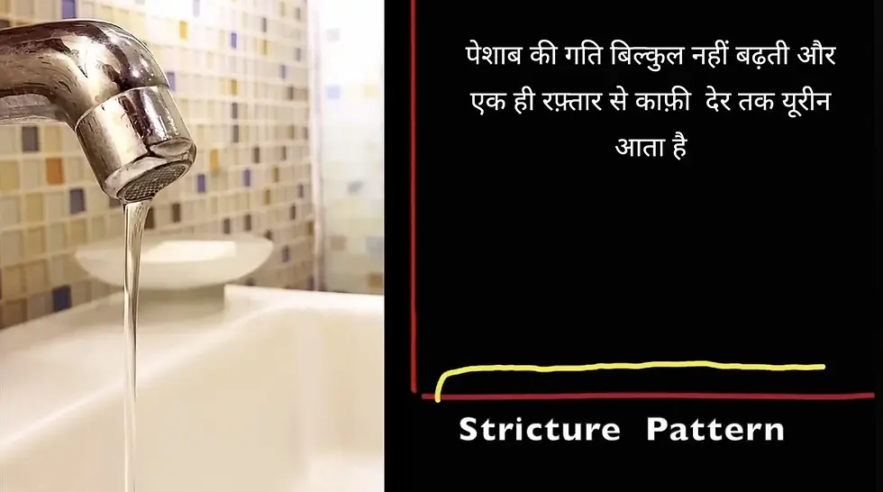 Understanding Urethral Stricture: A visual representation of the "Stricture Pattern" where urine flow remains slow and constant, rather than increasing in speed.