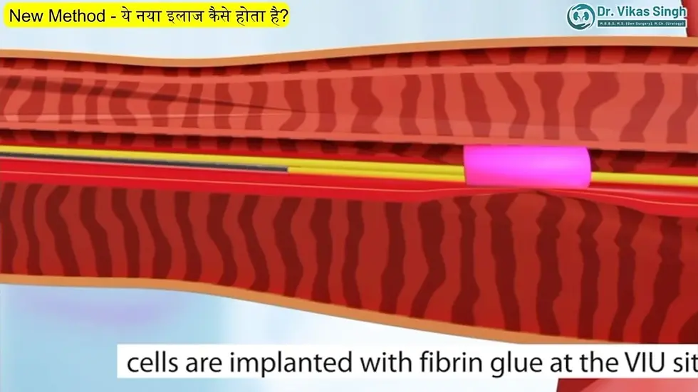 



"A look inside the specialized collisions and transport kit used for autologous cell-based regenerative therapy."