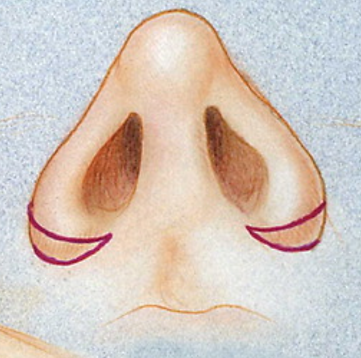 dessin de reduction narinaire