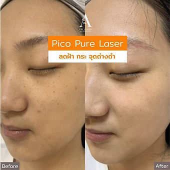 aki clinic pico pure laser 04.jpeg