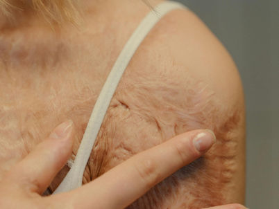 אישה מלטפת צלקת