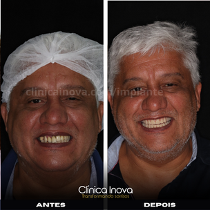Imagem mostrando um paciente sorrindo, satisfeita com o resultado de implante dentário.