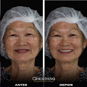 Imagem mostrando uma paciente sorrindo, satisfeita com o resultado de implante dentário.