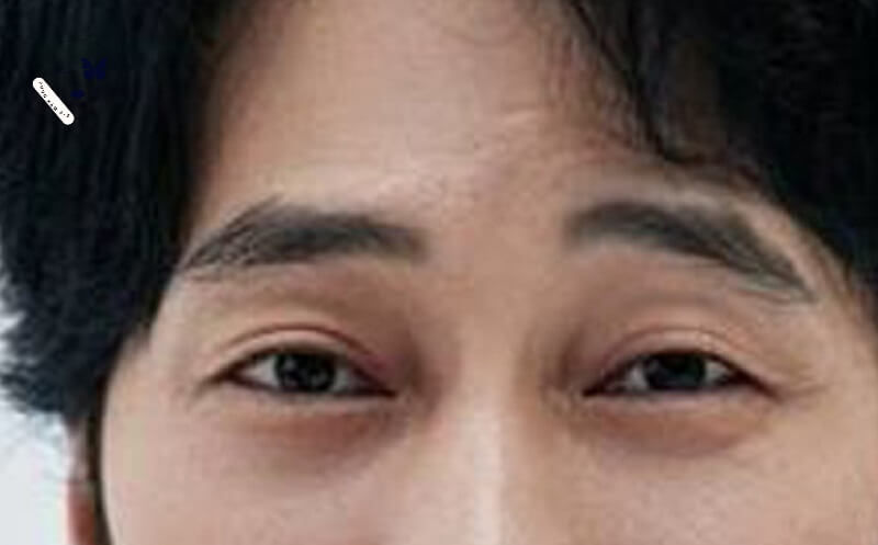 Chân mày cụp ở nam