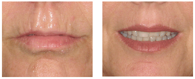 Lip Liner and Filter