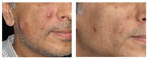 Before and after folliculitis treatmet on man in Beverly Hills