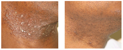 Before and after folliculitis treatmet on man in Beverly Hills