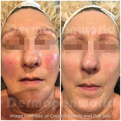 Microneedling before and after