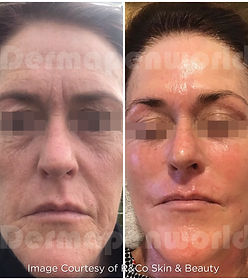 Microneedling before and after