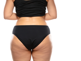 ¿Liposucción para eliminar la celulitis?