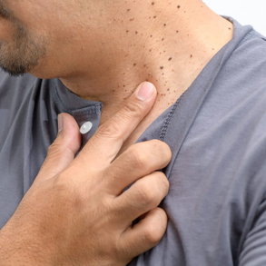 skin-tag-removal.webp