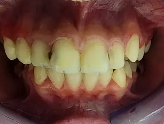 crowded-teeth-before-treatment.webp