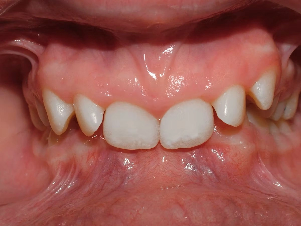 Severe deep bite in a child's mouth showing excessive vertical overlap of front teeth