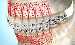 Accelerated orthodontics Sharjah for quick results with teen expertise by Dr. Srinivasa Rao Bogavilli at World Class Orthodontics.