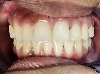 Post-treatment smile showing corrected midline and normalized overjet after TADs-supported orthodontic treatment in an 18‑year‑old female by Dr. Srinivas in Sharjah.