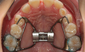 Rapid palatal Expansion