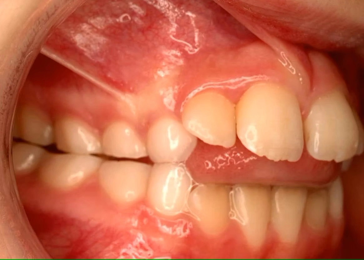 Tongue thrust causing open bite in a child - early orthodontic intervention needed