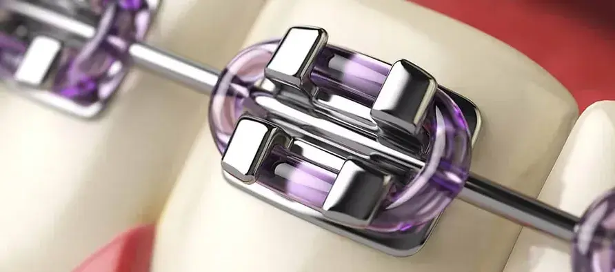 Close-up of color braces with a purple elastic ligature around a metal bracket on a tooth – aesthetic orthodontic option.