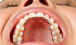 Lingual braces Sharjah for invisible alignment with Dr. Srinivasa Rao Bogavilli at World Class Orthodontics – discreet perfection.