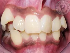Severe crowding before starting metal braces orthodontic treatment in Sharjah