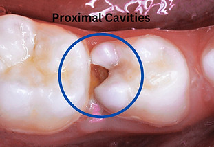 Proximal Cavity
