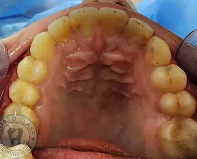 After treatment—upper occlusal arch showing expanded maxillary arch form, corrected crowding and ideal alignment, Dubai.