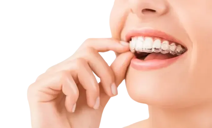 Clear aligner on upper teeth—nearly invisible tray (close‑up)