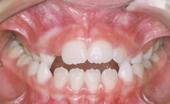 narrow upper jaw