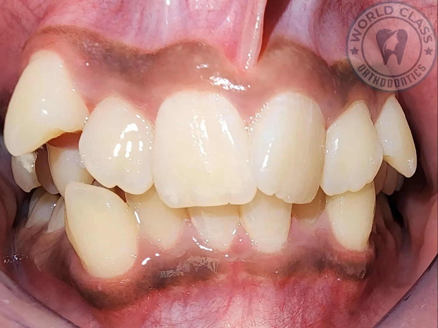 Dental crowding in a child showing overlapping and misaligned teeth in the upper and lower arches