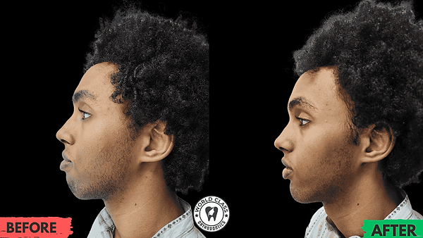Class III malocclusion profile correction before and after orthodontic treatment at World Class Orthodontics Dubai showing significant improvement in facial balance and jaw alignment