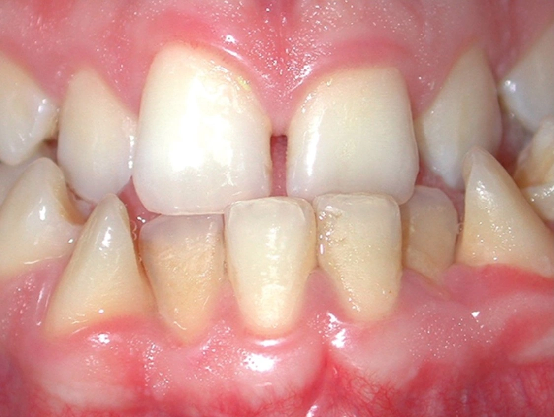 Anterior crossbite in a child's teeth showing misalignment of upper and lower front teeth