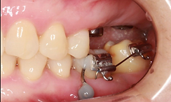 Adjunctive orthodontics Dubai for complex dental support with Dr. Srinivasa Rao Bogavilli at World Class Orthodontics – non-surgical solutions.