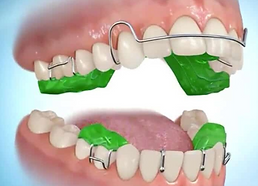 Functional appliance for lower jaw growth guidance in children