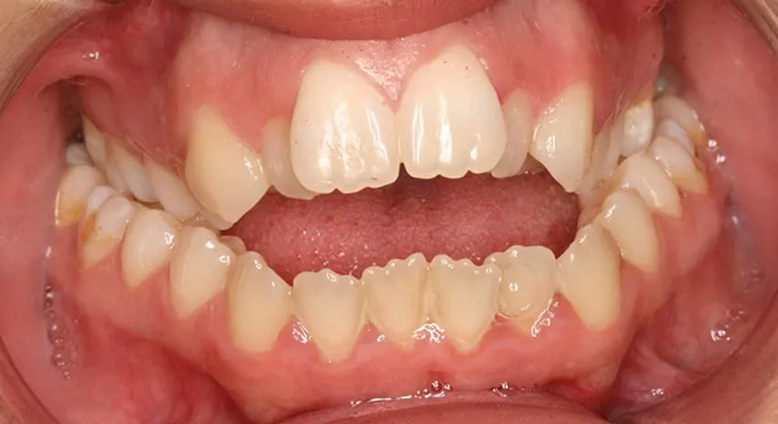 Anterior open bite in a child indicating orthodontic treatment need