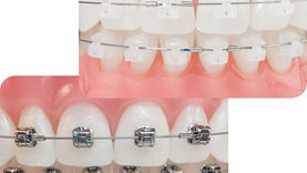 Featured image comparing ceramic braces and metal braces side by side – highlighting differences in appearance, comfort, and cost in Dubai and Sharjah
