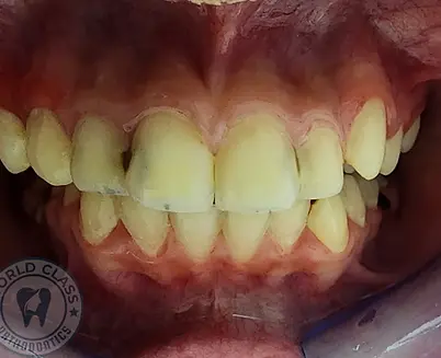 Frontal bite before orthodontic treatment—Class II malocclusion with teeth protruding, irregular alignment, Dubai.