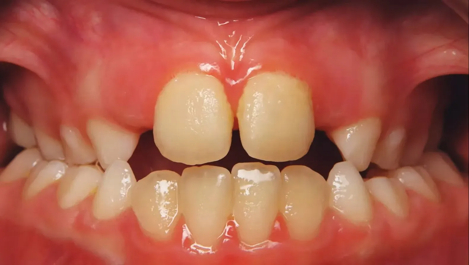 Posterior crossbite in a child with narrow upper arch - orthodontic condition
