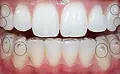 invisalign-attachments-close-up.webp.webp