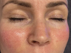 How We Stay Young - Hydradermabrasion