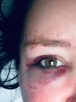 7 Hours, 1 Tumor, and 100 Prayers Later