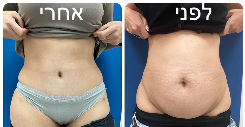חצי שנה אחרי מתיחת בטן
