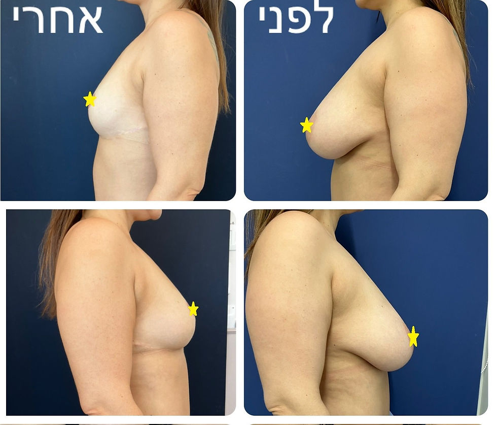 שנה אחרי הקטנת שדיים