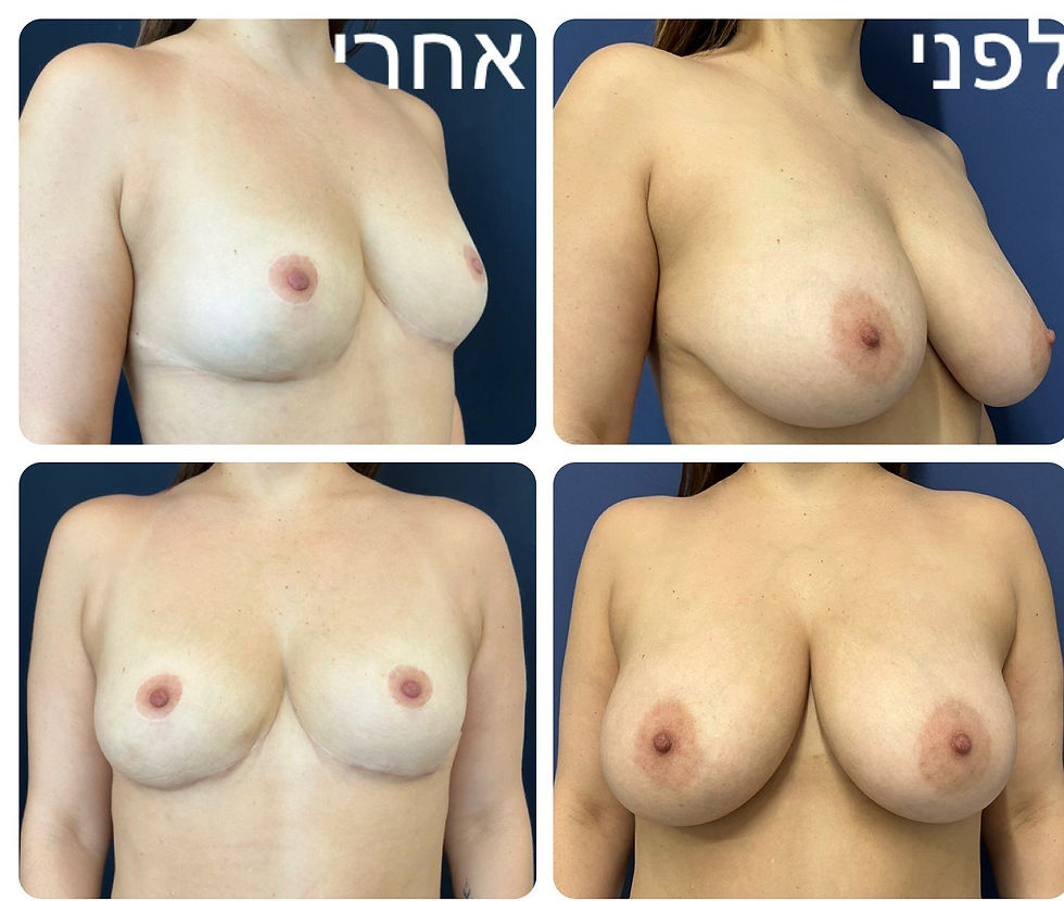 שנה אחרי הקטנת שדיים