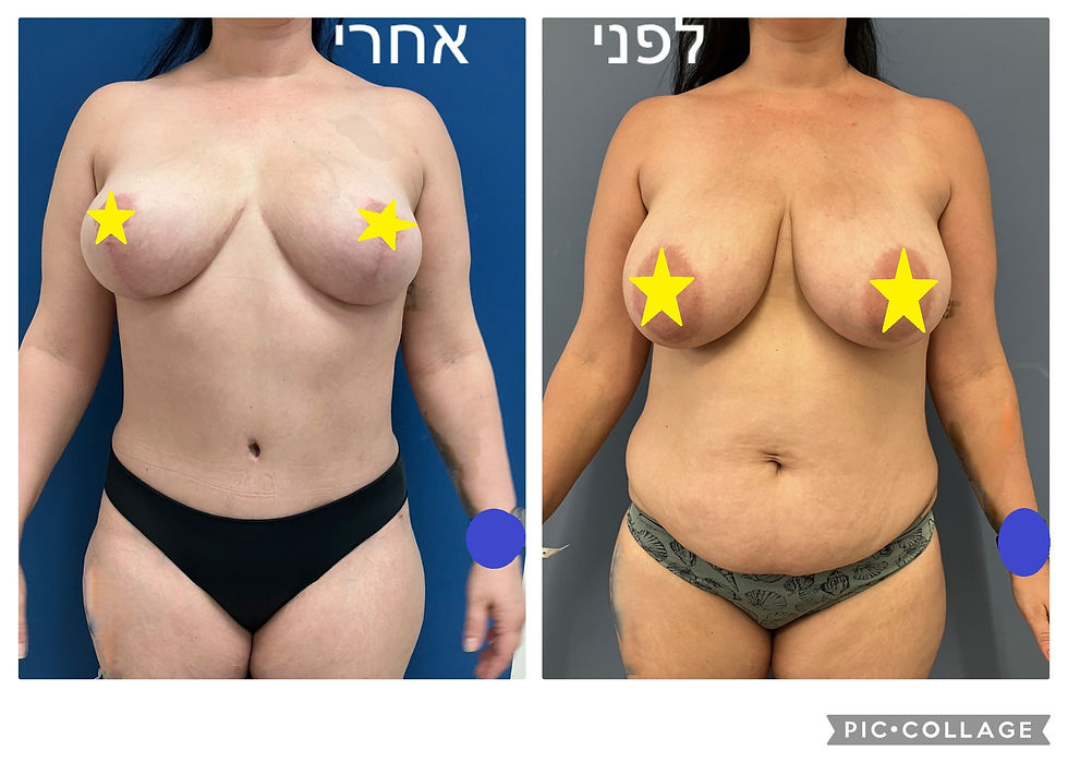 חצי שנה אחרי מתיחת בטן והקטנת שדיים